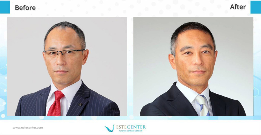 before after